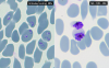 These images show the malaria parasites before and after treatment. Without MK-7602, parasites (purple) invade red blood cells (blue) after two days. With MK-7602, they are trapped inside cells, halting the malaria cycle and blocking transmission.