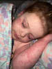 Severe eczema robs kids of a normal childhood, affecting their health and emotional wellbeing.