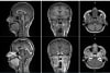 First-in-human contrast enhanced MRI images with GE HealthCare's mangaciclanol