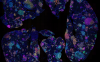 This image shows tumours growing in a mouse lung, with the colours indicating different gene deletions. The team used mouse models in the study to show the protein signature reflects an altered inflammatory lung environment before cancer takes hold.
