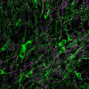 New stem cell therapy aims to 'turn back the clock' on Parkinson's disease 