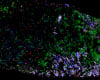 Gamma delta T cells (red) infiltrating a small cell lung cancer (SCLC) patient's tumour (white). WEHI researchers have found these immune cells can detect and kill SCLC cells, findings that could help transform treatment options for the disease. 