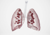 Known medically as pulmonary fibrosis, lung scarring is an incurable condition where the lungs gradually stiffen.