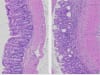 Mice fed a normal diet (left) have healthy, well-organised gut tissue. In contrast, mice fed a diet high in fat (right) have disrupted gut tissue, thickening of the gut wall (pink) and an accumulation of immune cells (purple dots)-clear signs of IBD.