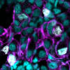 A section of liver tumour in a zebrafish shows liver cell DNA (cyan), cancer cells with KRAS activity (purple), and DNA damage (white). Credit: WEHI