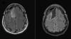 Brain scans from a patient in the world-first clinical trial, where researchers were able to compare tumour samples taken before treatment (left) and after treatment (right). 