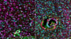 Analysis of brain tumour samples before (left) and after treatment (right) revealed increased immune activation (shown in green), following treatment with the IDH inhibitor. 